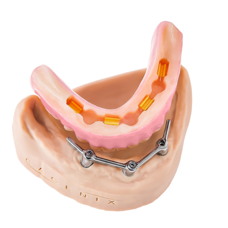 AccuFrame Overdenture product image
